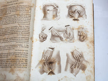 Load image into Gallery viewer, Two Vol. Set of Smith&quot;s Operative Surgery by Henry H. Smith, 2nd edition. 1856, Well Illustrated.
